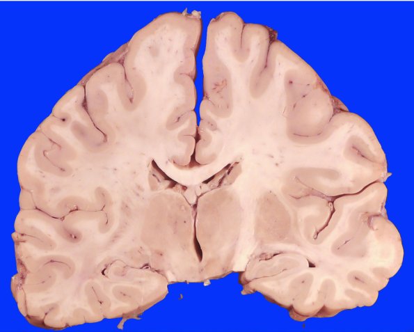 19C7 CA SDH (Case 19) Gross_11