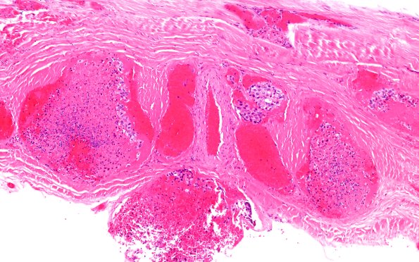 19F2 CA SDH N16 (Case 19) H&E 10X