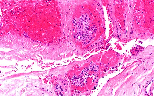 19F4 CA SDH (Case 19) H&E 20X