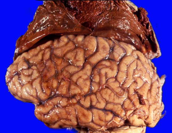 1A1 Hemorrhage, subdural, brain contours changed (Case 1) 3