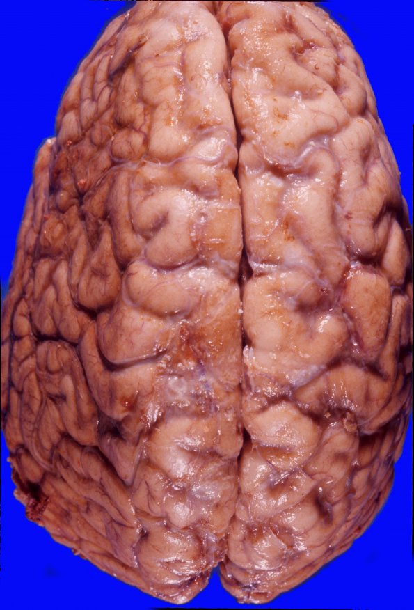 1A3 Hemorrhage, subdural, brain contours changed (Case 1) 1