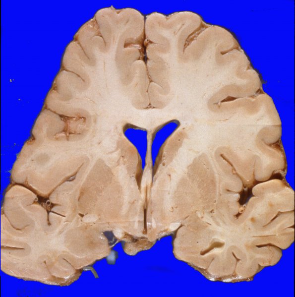 1A4 Hemorrhage, subdural, brain contours changed (Case 1) 1A