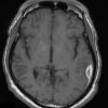 2A1 Hemorrhage, sudural (Case 2) T1 1 - Copy