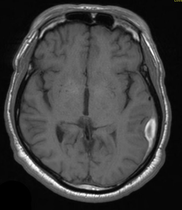 2A1 Hemorrhage, sudural (Case 2) T1 1 - Copy