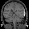 2A2 Hemorrhage, sudural (Case 2) T1 2 - Copy