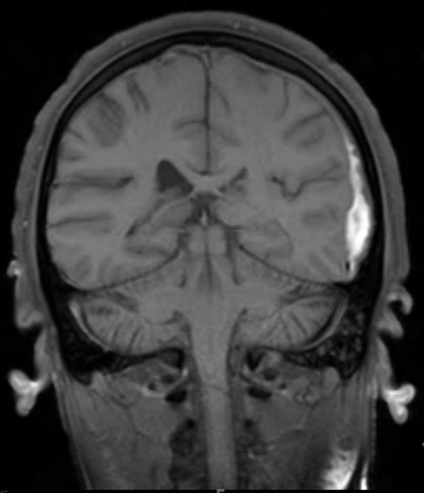 2A2 Hemorrhage, sudural (Case 2) T1 2 - Copy