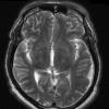 2A3 Hemorrhage, sudural (Case 2) T2 1 - Copy