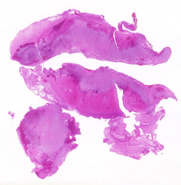 2B1 Hemorrhage, subdural, organizing (Case 2) H&E  whole mount