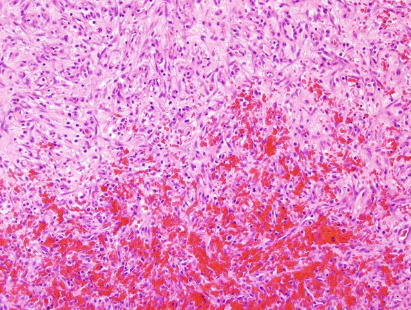 2B2 Hemorrhage, subdural, organizing (Case 2) H&E 1