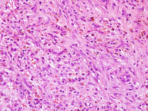 2B3 Hemorrhage, subdural, organizing (Case 2) H&E 2