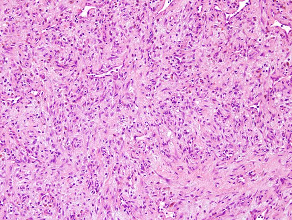 2B4 Hemorrhage, subdural, organizing (Case 2) H&E 7