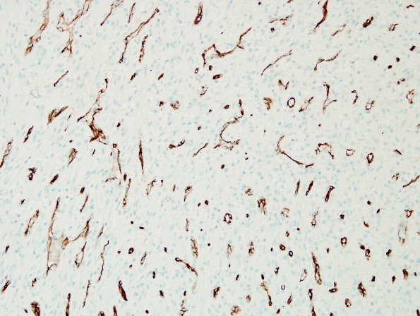 2C1 Hemorrhage, subdural, organizing (Case 2) CD34 1