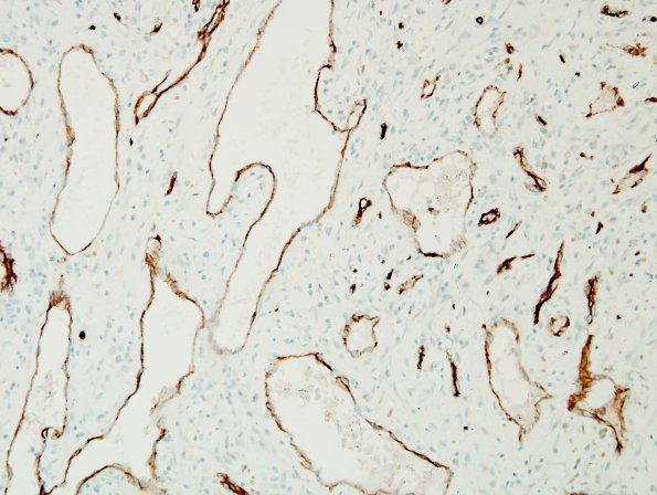 2C2 Hemorrhage, subdural, organizing (Case 2) CD34 2