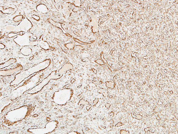 2D1 Hemorrhage, subdural, organizing (Case 2) SMA 7