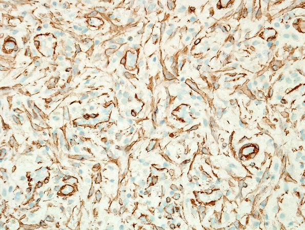 2D2 Hemorrhage, subdural, organizing (Case 2) SMA 2