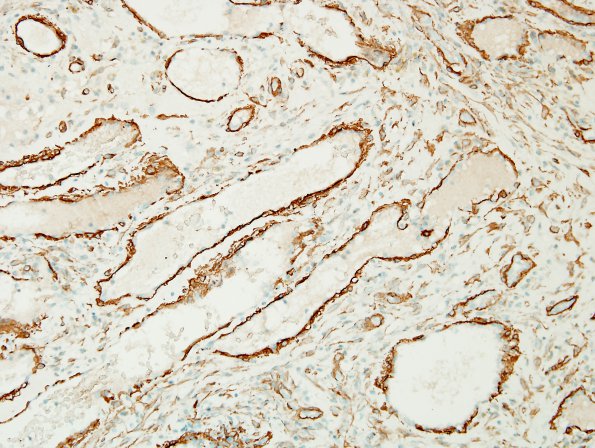 2D3 Hemorrhage, subdural, organizing (Case 2) SMA 4