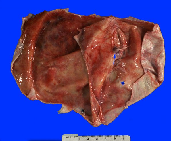 3A1 Hemorrhage, subdural & shunt (Case 3) _1A copy