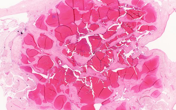 3A4 Hemorrhage, subdural & shunt (Case 3) N35 H&E 2X
