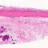 3B1 Hemorrhage, subdural & shunt (Case 3) N34 H&E 2X