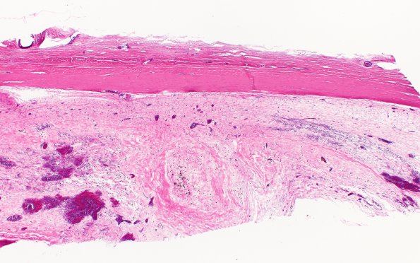 3B1 Hemorrhage, subdural & shunt (Case 3) N34 H&E 2X