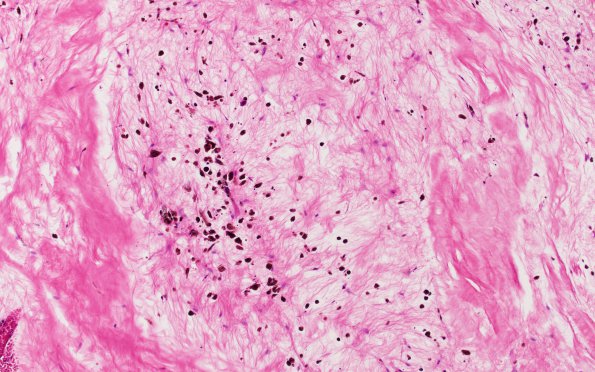 3B2 Hemorrhage, subdural & shunt (Case 3) N33 H&E 10X