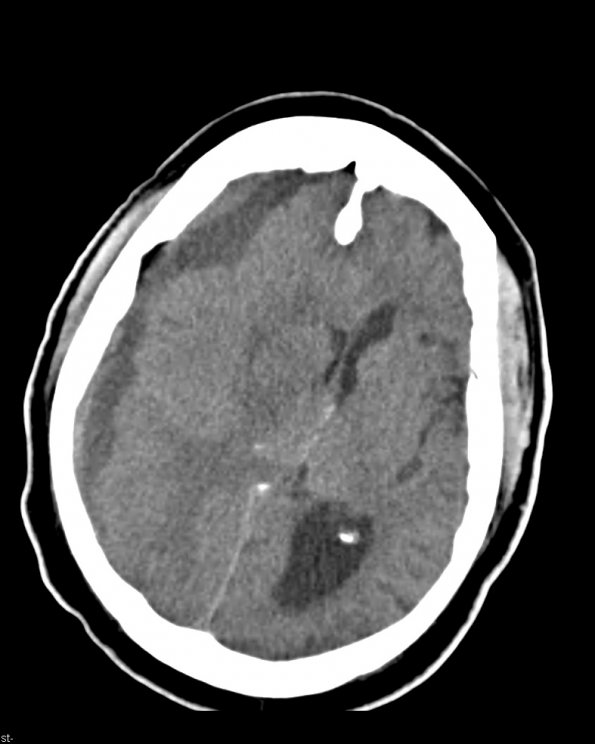 4A1 Hemorrhage, subdural, organizing (EMH) (Case 4) CT 1 - Copy
