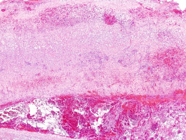 4B2 Hemorrhage, subdural, organizing (EMH) (Case 41) H&E 16