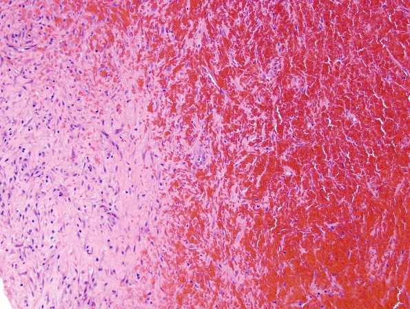 4B3 Hemorrhage, subdural, organizing (EMH) (Case 4) H&E 1