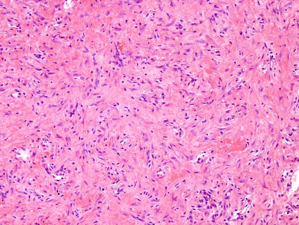 4B4 Hemorrhage, subdural, organizing (EMH) (Case 4) H&E 6