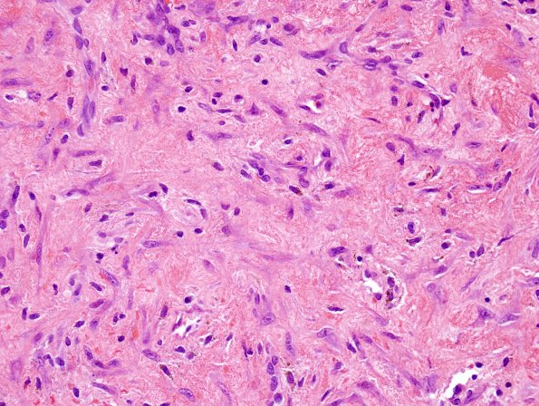 4B5 Hemorrhage, subdural, organizing (EMH) (Case 4) H&E 7