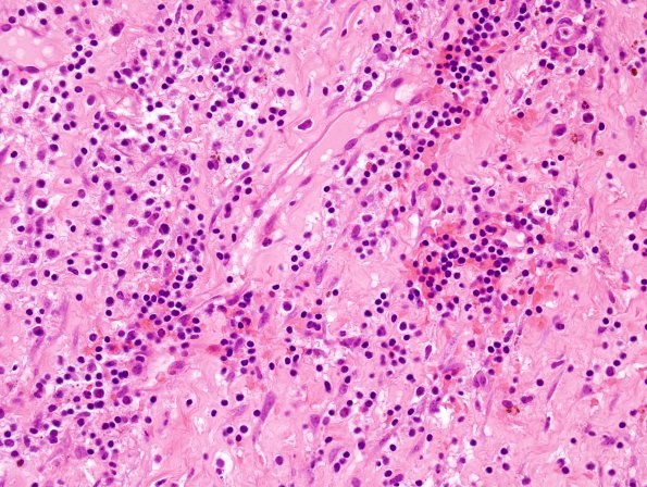 4C1 Hemorrhage, subdural, organizing (EMH) (Case 4) H&E 4