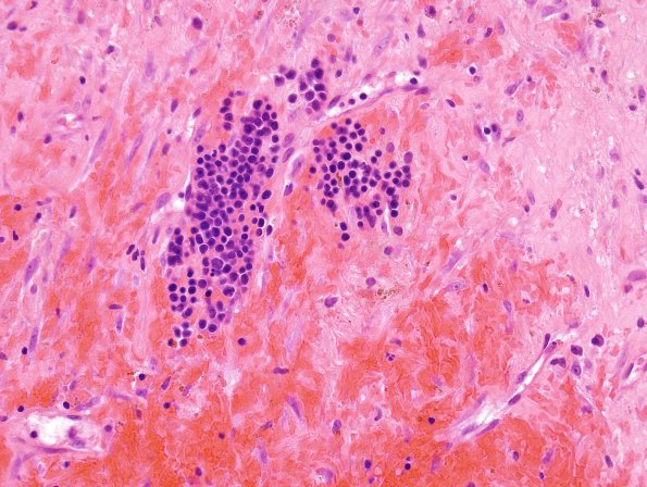 4C2 Hemorrhage, subdural, organizing (EMH) (Case 4) H&E 5