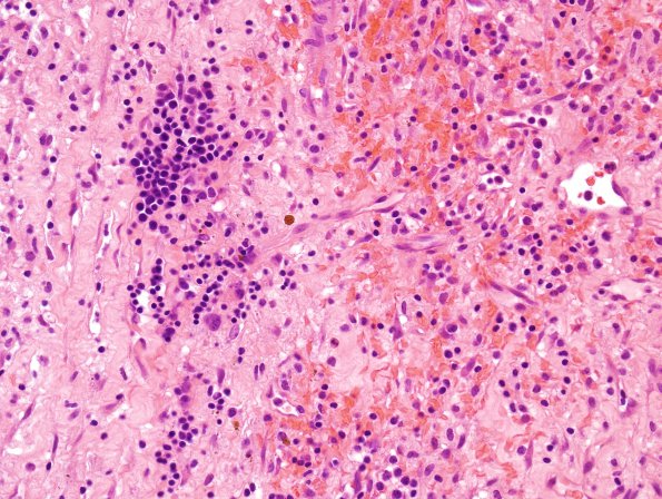 4C3 Hemorrhage, subdural, organizing (EMH) (Case 4) H&E 8