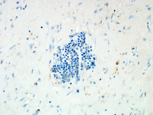 4C6 Hemorrhage, subdural, organizing (EMH) (Case 4) MyeloPeroxidaseX