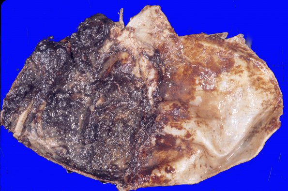 5A1 Hemorrhage, subdural (Case 5) 3