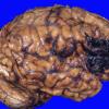 5A2 Hemorrhage, subdural (Case 5) 5