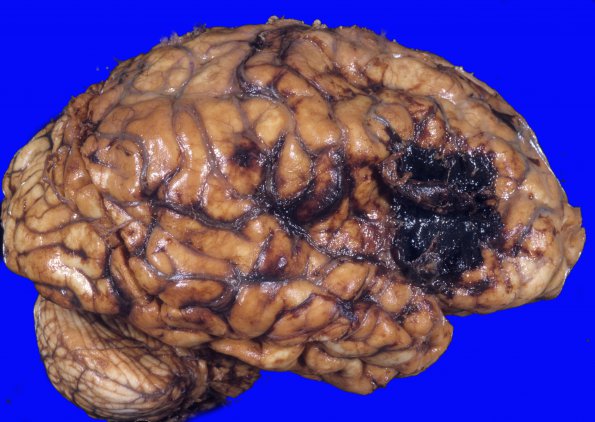 5A2 Hemorrhage, subdural (Case 5) 5