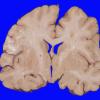 5A3 Hemorrhage, subdural (Case 5) 2