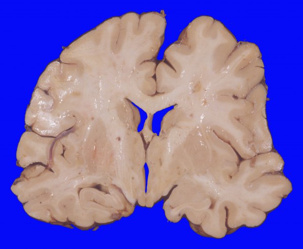 5A3 Hemorrhage, subdural (Case 5) 2