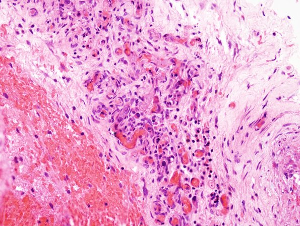 6A2 Hemorrhage, subdural, tumor cells (Case 6) H&E 7