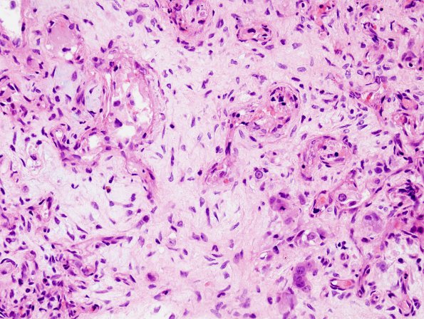 6A3 Hemorrhage, subdural, tumor cells (Case 6) H&E 1