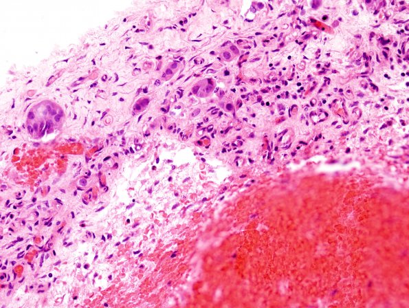 6A4 Hemorrhage, subdural, tumor cells (Case 6) H&E 6