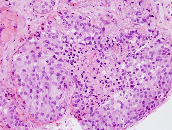 6A5 Hemorrhage, subdural, tumor cells (Case 6) H&E 8.