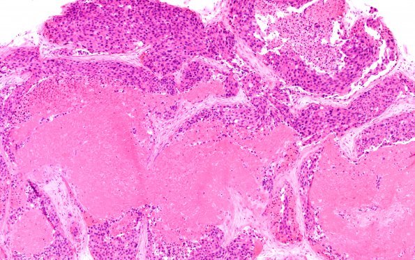 6A6 Hemorrhage, subdural, breast CA tumor cells (Case 6) H&E 10X