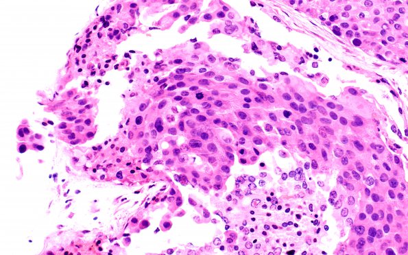 6A7 Hemorrhage, subdural, breast CA tumor cells (Case 6) H&E 40X