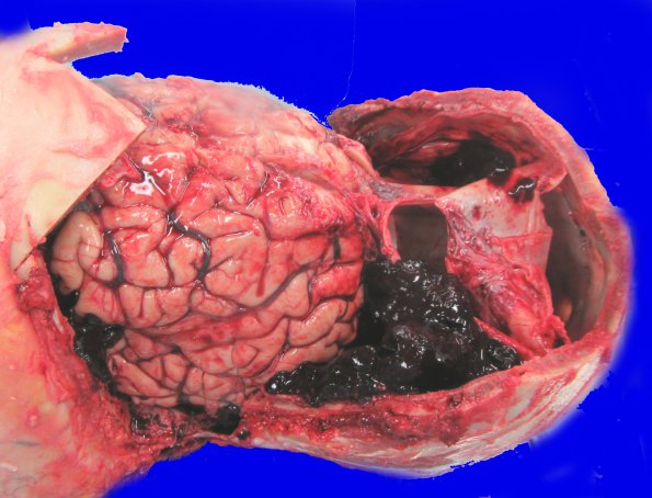 7A1 Hemorrhage, subdural (SDH) with Herniation (Case 7) Gross 2