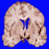 7A2 SDH, herniation (Case 7) _2