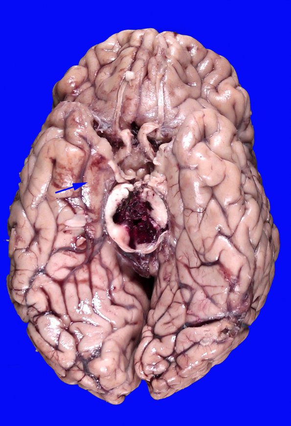 7A3 Hemorrhage, subdural (SDH) with Herniation (Case 7)_3 copy