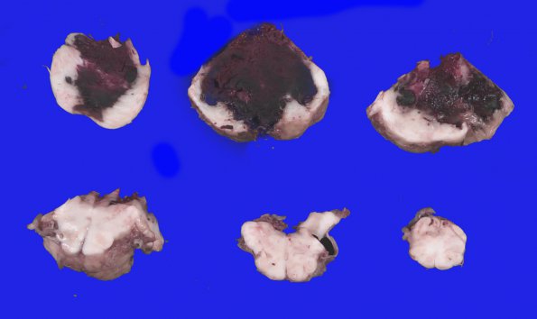 7A4 Hemorrhage, subdural (SDH) with Herniation (Case 7)_10