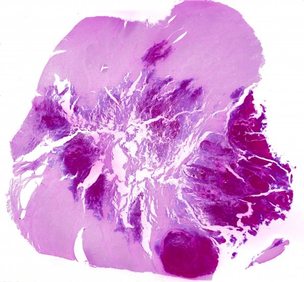 7B Hemorrhages, Duret (Case 7) H&E 1